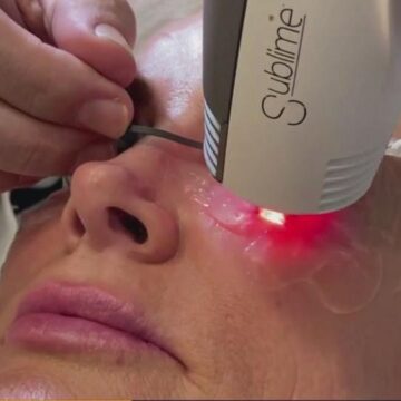 New treatment for dry eyes also zaps wrinkles